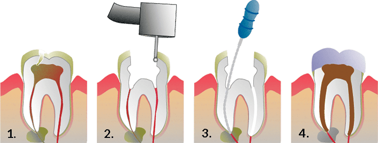 Root Canal Treatment in Vadodara