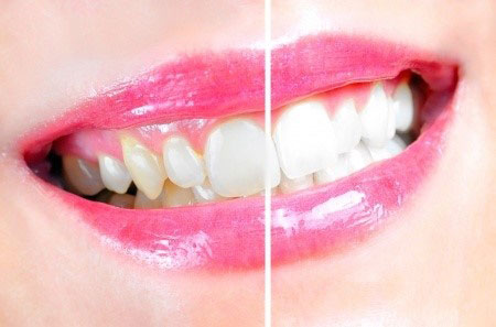 Teeth Whitening