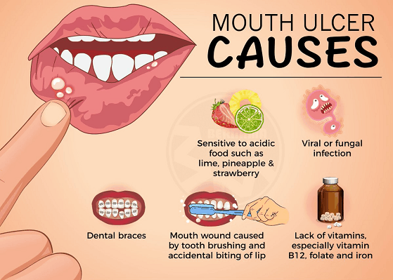 ULCERS