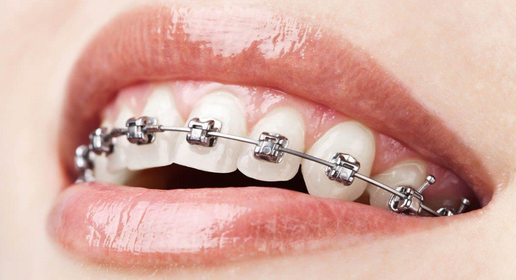 orthodontic treatment