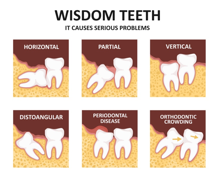 WISDOM TOOTH REMOVAL