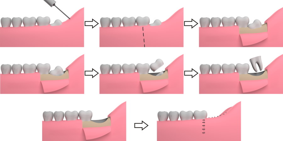 WISDOM TOOTH REMOVAL