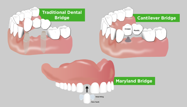 DENTAL BRIDGES