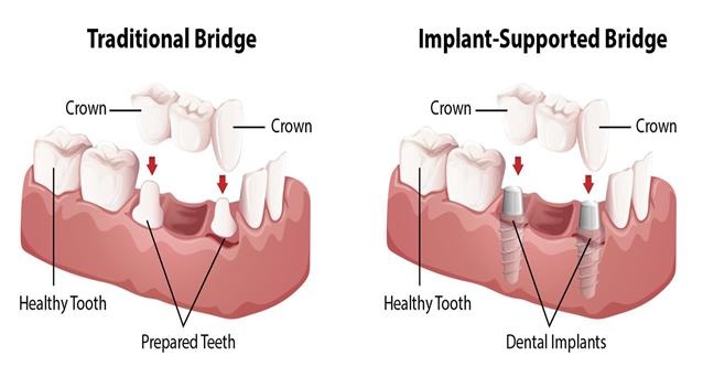 TRADITIONAL DENTAL BRIDGES